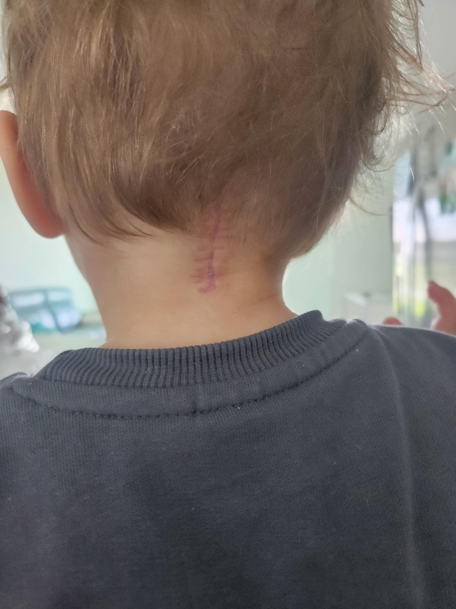 The scar from Max's surger on the back of his head