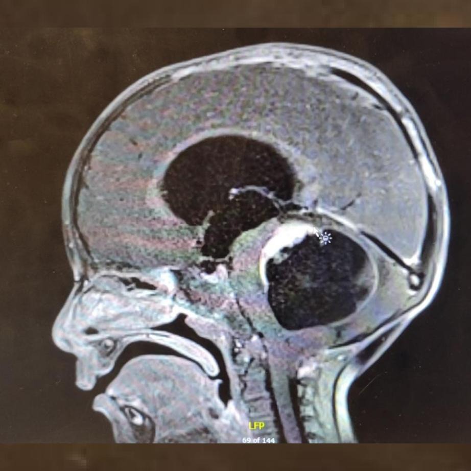A scan of Max's brain showing a large tumor